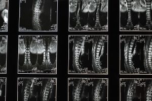 Types of Bakersfield spinal cord injuries shown as x-ray images